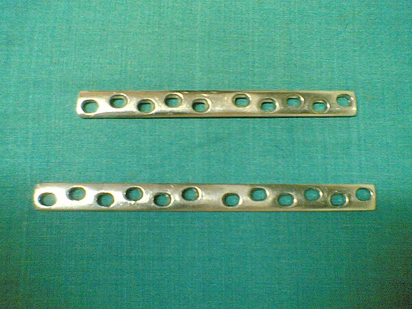 Distal Femur Locked Plate